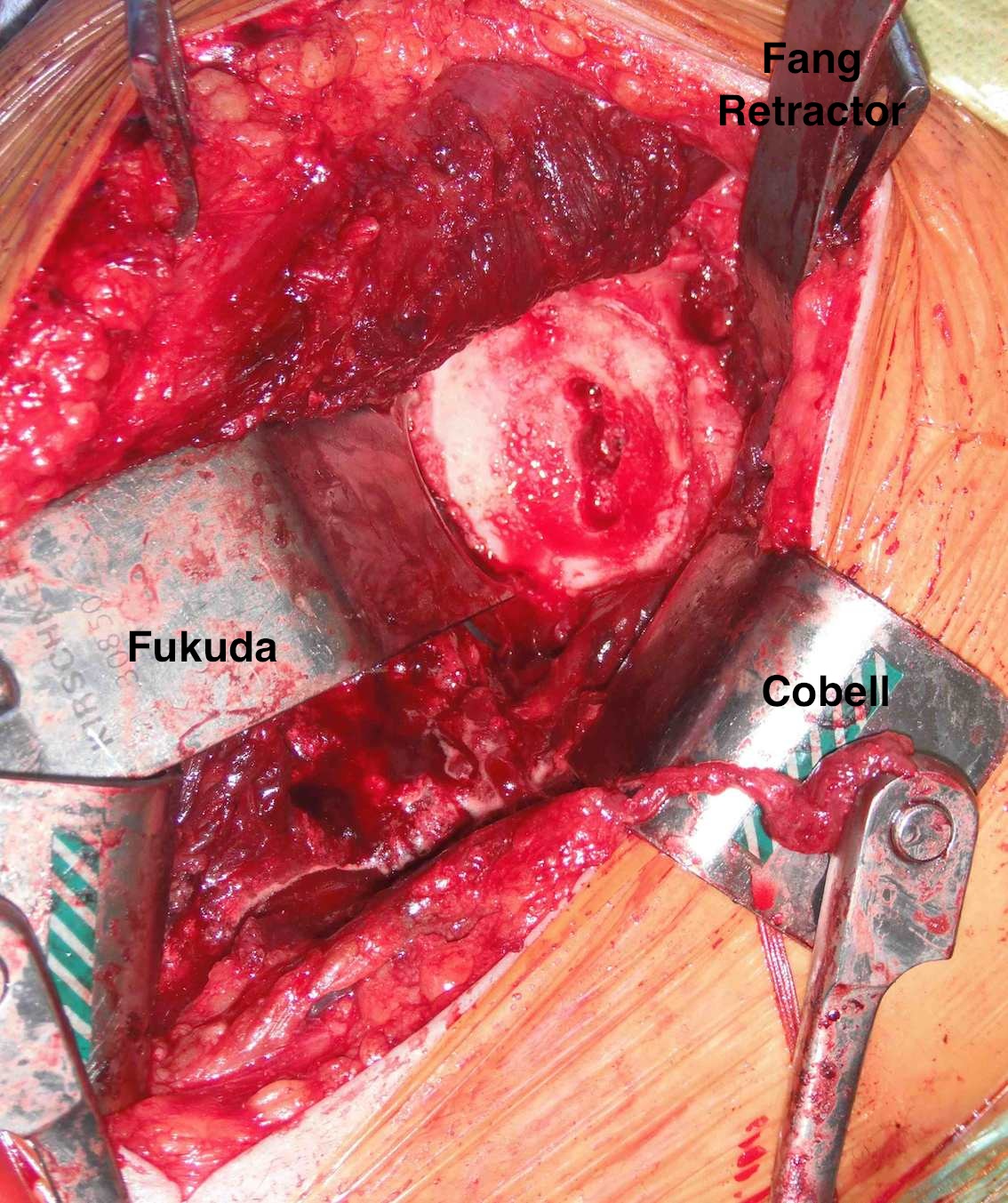 TSR Glenoid Exposure 2